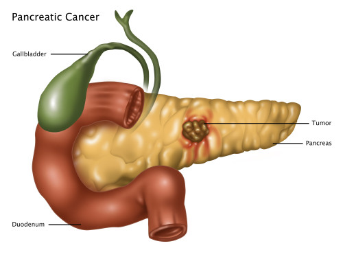 Pancreatic Cancer, Illustration Poster Print by Gwen Shockey/Science Source - Item # VARSCIJA8122