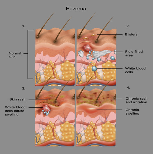 Eczema Poster Print by Gwen Shockey/Science Source - Item # VARSCIBW7440