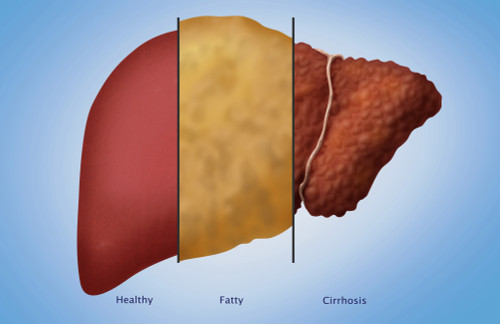 Healthy, Fatty, and Cirrhotic Liver Poster Print by Monica Schroeder/Science Source - Item # VARSCIBY6935