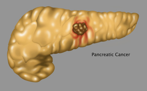 Pancreatic Cancer, Illustration Poster Print by Gwen Shockey/Science Source - Item # VARSCIJA8129