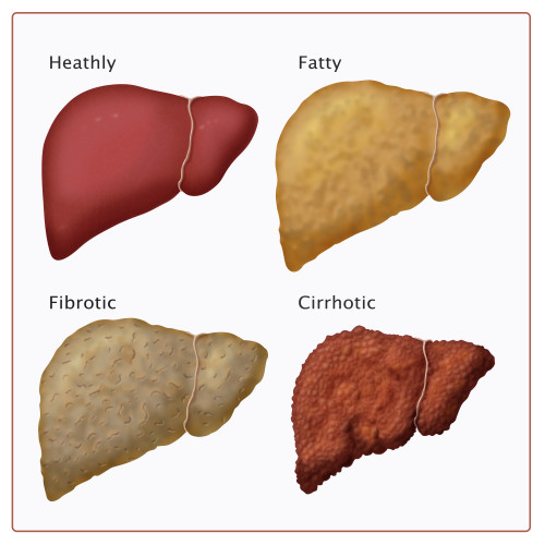 Stages of Liver Damage Poster Print by Monica Schroeder/Science Source - Item # VARSCIBY6899