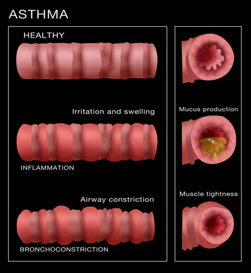 Bronchoconstriction, Asthma Poster Print by Monica Schroeder/Science Source