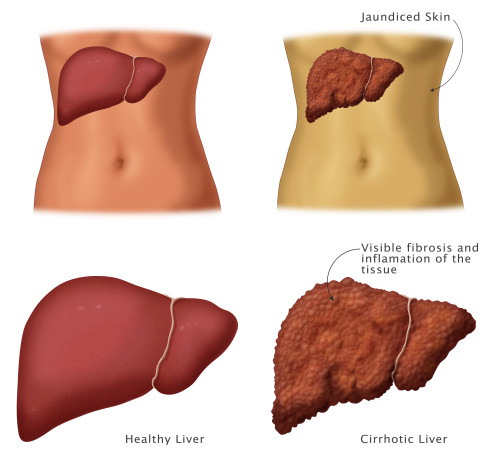 Healthy vs. Cirrhotic Liver Poster Print by Monica Schroeder/Science Source - Item # VARSCIBY6927
