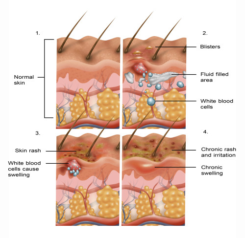 Eczema Poster Print by Gwen Shockey/Science Source - Item # VARSCIBW7442