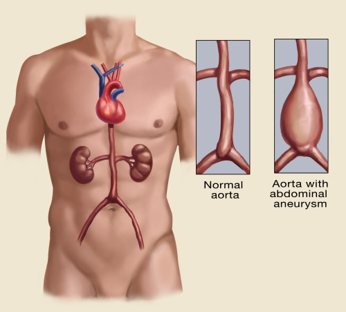 Abdominal Aneurysm Poster Print by Spencer Sutton/Science Source - Item # VARSCIBZ8020