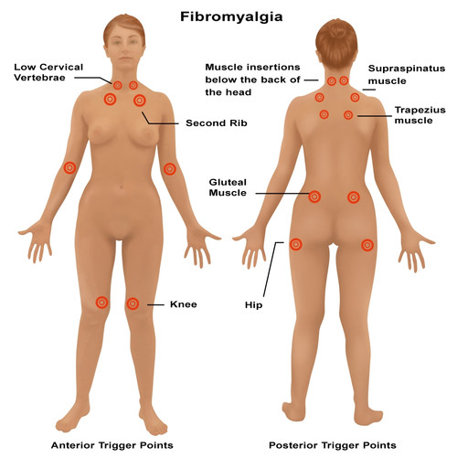 Fibromyalgia Poster Print by Gwen Shockey/Science Source - Item # VARSCIBW7444