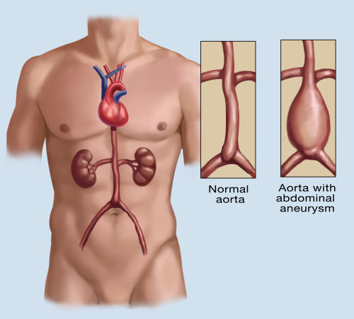Abdominal Aneurysm Poster Print by Spencer Sutton/Science Source - Item # VARSCIBZ8021