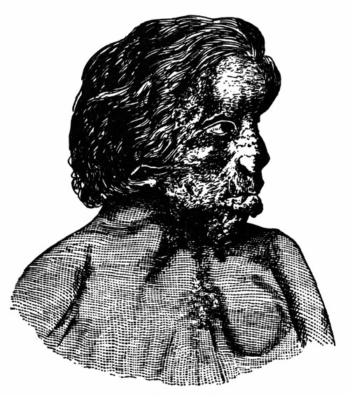 Joseph Merrick (1864-1890). /Nenglish Medical Anomaly, Known As The Elephant Man. Poster Print by Granger Collection - Item # VARGRC0036287