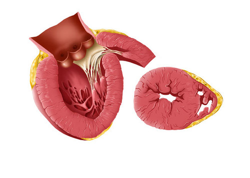 Enlarged left ventricle of the human heart Poster Print by TriFocal Communications/Stocktrek Images - Item # VARPSTTRF700049H
