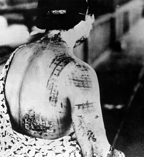 Injured Female Survivor'S Of Nagasaki History - Item # VAREVCHISL037EC369