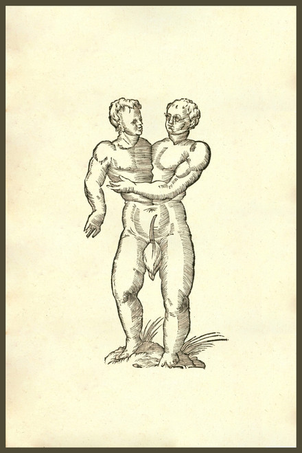 Infans biceps obscaeno membro, 407, two heads on one body, siamese twins.   From the 1642 book Monstrorum Historia by Ulisse Aldrovandi .   He is considered the founder of modern Natural History. Poster Print by Ulisse Aldrovandi - Item # VARBLL05874