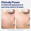 CETAPHIL Gentle Clear Repairing Post-Acne Serum, Retinol Alternative, Oil Free Serum for Sensitive Skin, 1 Fl Oz, Bakuchiol, Improves Skin Tone & Post-acne Marks, Dermatologist Recommended Brand
