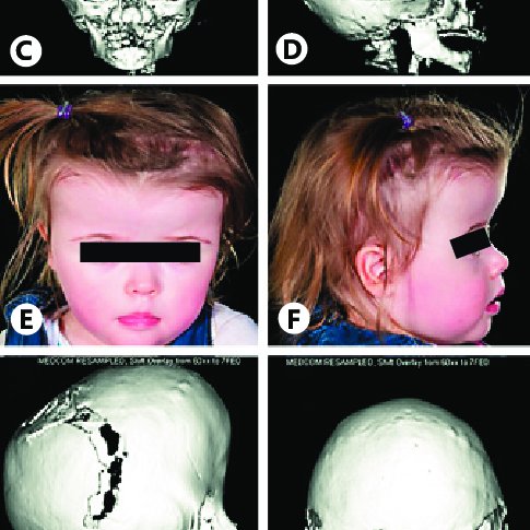 saethre-chotzen-syndrome-a-b-phenotypic-features-including-brachycephaly-and-a-tall-q640.jpg