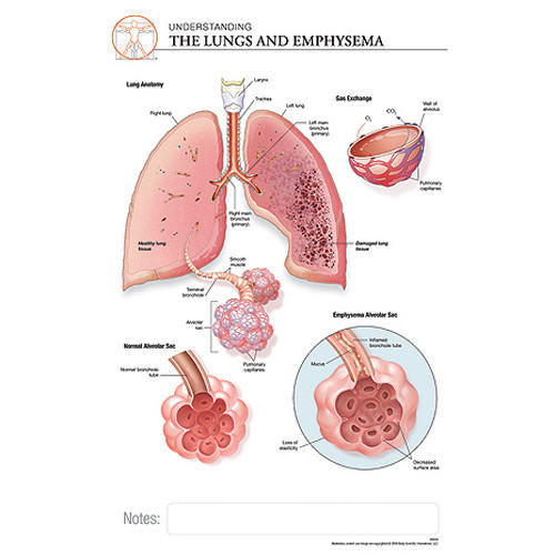 Fischer Technical Company Fischer Technical BS314, Emphysema "Post It" Chart (pk of 10) 