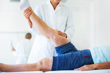 Varicose Veins Explained