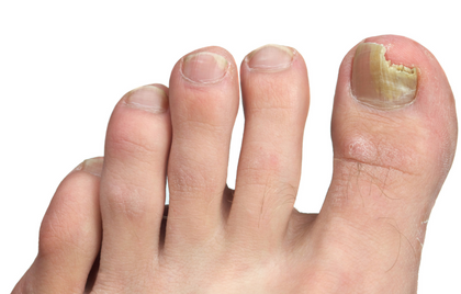 Blog - Identifying Toenail Fungus and What to Do About It