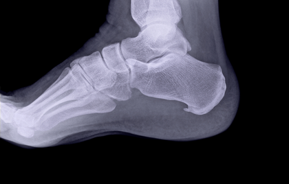 These Are the Common Causes of Heel Spurs
