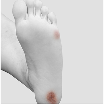 Close up of diabetic foot.