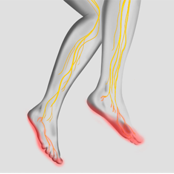 Close up of feet with neuropathy