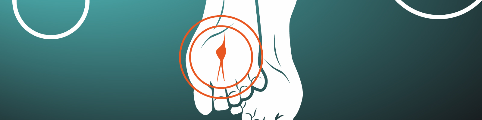 Morton's Neuroma