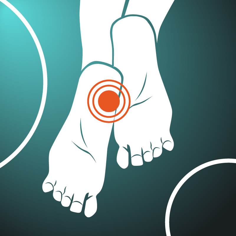 Plantar Fasciitis