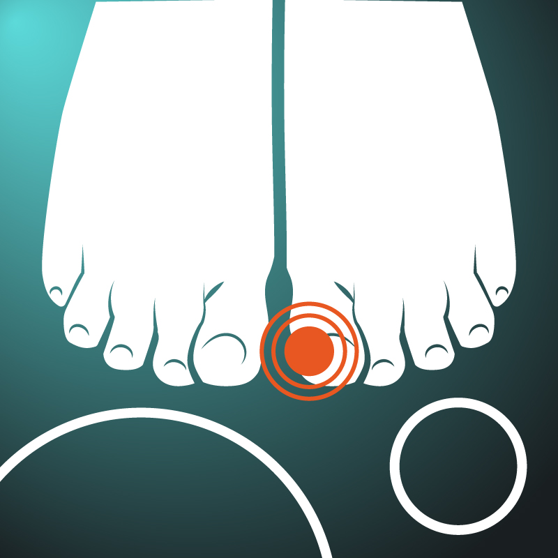 Toenail Fungus