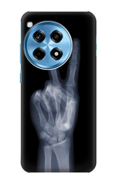 S3101 X-ray Peace Sign Fingers Case Cover Custodia per OnePlus 12R