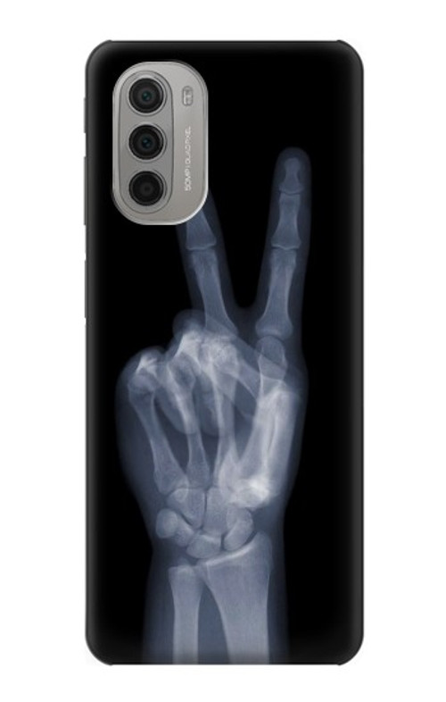 S3101 X-ray Peace Sign Fingers Case Cover Custodia per Motorola Moto G51 5G S3101 X-ray Peace Sign Fingers Case Cover Custodia per Motorola Moto G51 5G