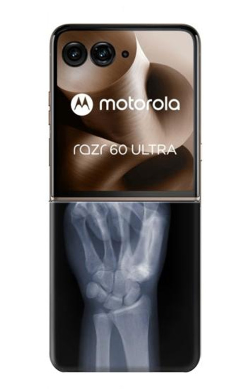 S3101 X-ray Peace Sign Fingers Case Cover Custodia per Motorola Razr 60 Ultra, Razr Ultra 2025