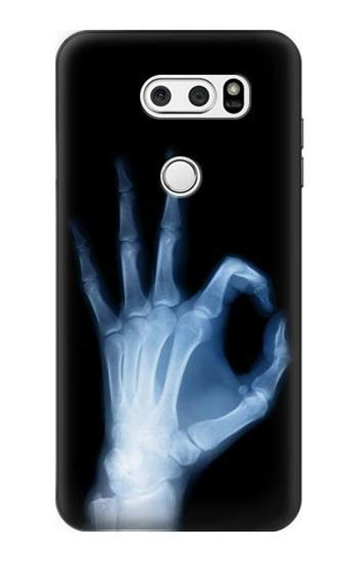 S3239 X-Ray Hand Sign OK Case Cover Custodia per LG V30, LG V30 Plus, LG V30S ThinQ, LG V35, LG V35 ThinQ