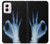 S3239 X-Ray Hand Sign OK Case Cover Custodia per Motorola Moto G Power 5G (2024) S3239 X-Ray Hand Sign OK Case Cover Custodia per Motorola Moto G Power 5G (2024)