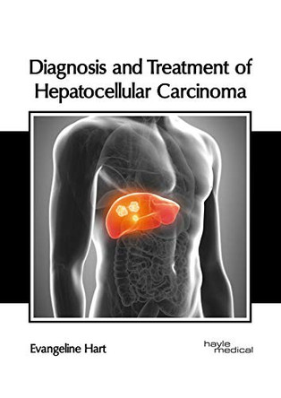 Diagnosis and Treatment of Hepatocellular Carcinoma by Evangeline Hart 9781632418517