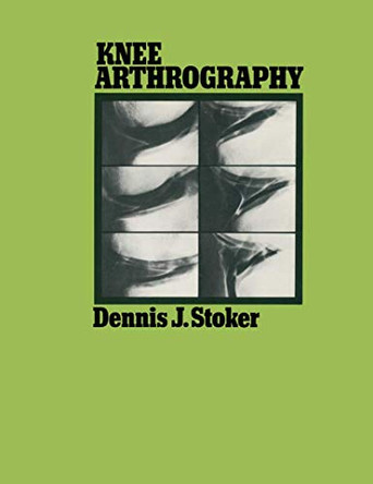 Knee Arthrography by Dennis J. Stoker 9780412218606