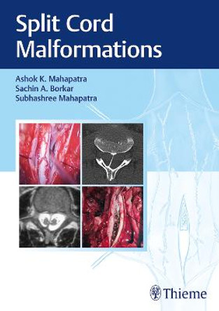 Split Cord Malformations by Ashok Mahapatra