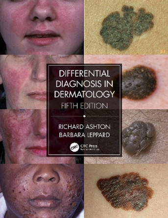 Differential Diagnosis in Dermatology by Richard Ashton 9780367085971