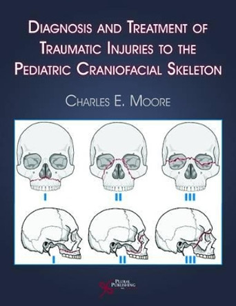 Diagnosis and Treatment of Traumatic Injuries to the Pediatric Craniofacial Skeleton by Charles E. Moore 9781597561402