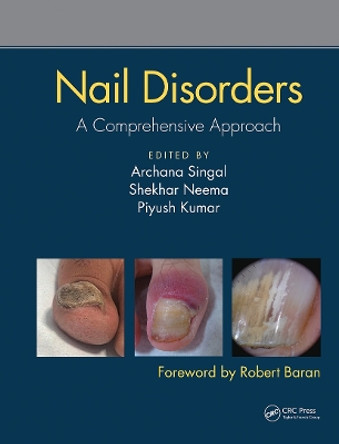 Nail Disorders: A Comprehensive Approach by Archana Singal 9780815378341