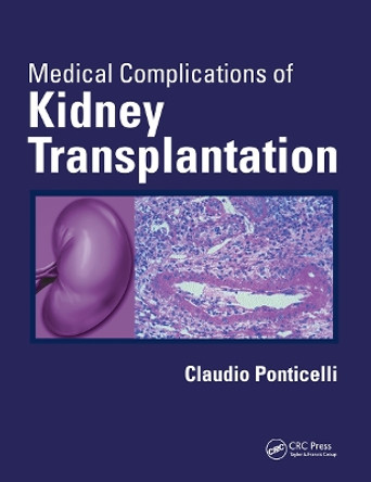 Medical Complications of Kidney Transplantation by Claudio Ponticelli 9780367446215