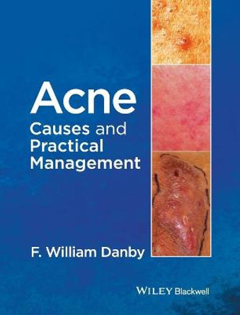 Acne: Causes and Practical Management by F. William Danby