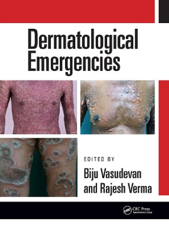 Dermatological Emergencies by Rajesh Verma 9780815378075