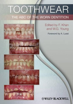 Toothwear: The ABC of the Worn Dentition by Farid Khan 9781444336559