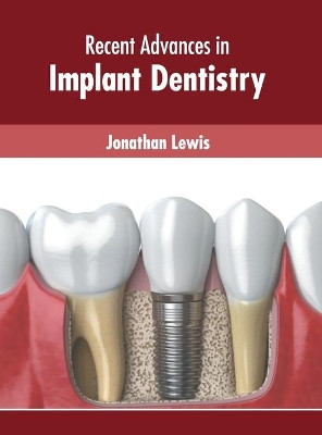 Recent Advances in Implant Dentistry by Jonathan Lewis 9781639874767