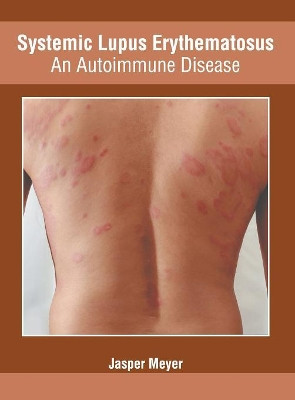 Systemic Lupus Erythematosus: An Autoimmune Disease by Jasper Meyer 9781632428523