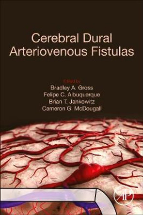 Cerebral Dural Arteriovenous Fistulas by Bradley A. Gross