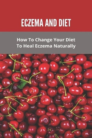Eczema And Diet: How To Change Your Diet To Heal Eczema Naturally: How To Treat Eczema With Diet by Wendell Marguez 9798740563718