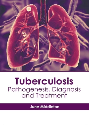 Tuberculosis: Pathogenesis, Diagnosis and Treatment by June Middleton 9798887405391