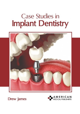 Case Studies in Implant Dentistry by Drew James 9798887406053