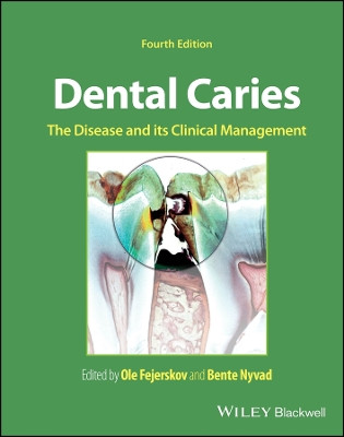 Dental Caries: The Disease and its Clinical Management Ole Fejerskov 9781119679370