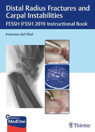 Distal Radius Fractures and Carpal Instabilities: FESSH IFSSH 2019 Instructional Book by Francisco del Pinal