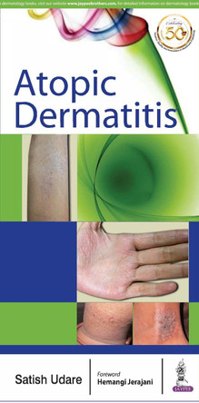 Atopic Dermatitis by Satish Udare 9789352702275